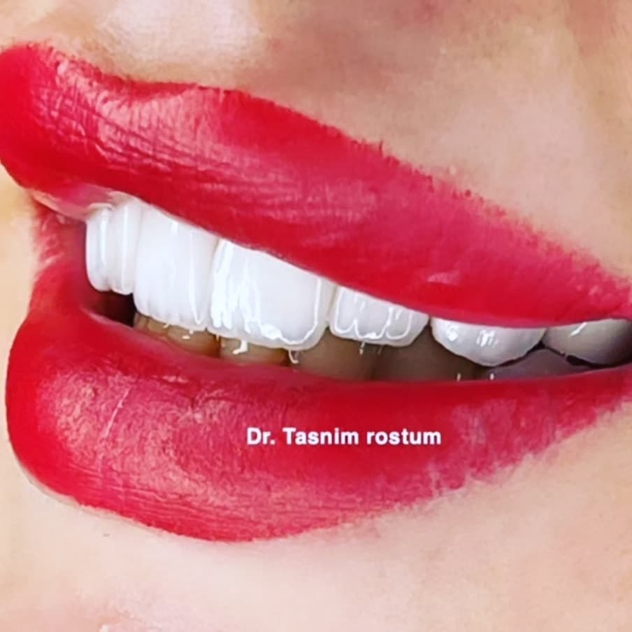 ابتسامة هوليوود - نتيجة مثالية